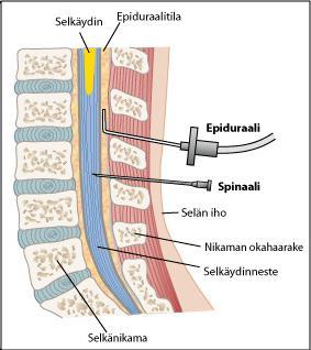 33 KUVIO 5. Spinaalinen ja epiduraalinen kivunhoito.