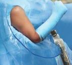 upper-limb trauma and total shoulder arthroplasty Achieve hyperflexion, full