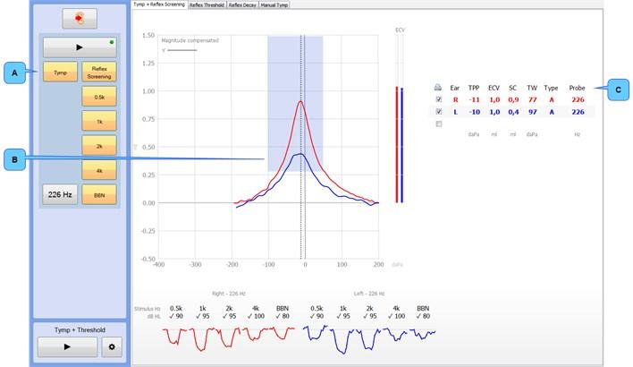 A. Ohjauspaneelin valinnat B. Tympanometriakäyrä C. Tulostaulukko A. Ohjauspaneelin valinnat Mittaustyyppi ja mittapään äänes hertseinä. B. Tympanometriakäyrä Kaavioalue näyttää tympanometriset käyrät ja voi skaalautua automaattisesti käyrien mukaan.