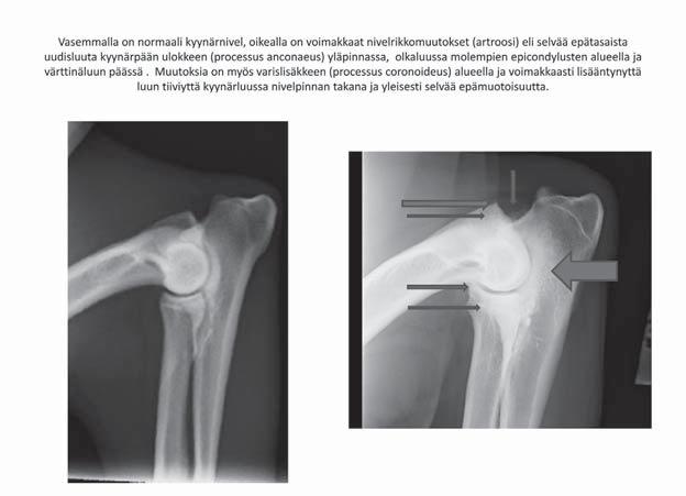 Lonkkanivelen anatomiaa... Terveys Vahvat nivelsiteet (kollateraaliligamentit) menevät molemmin puolin nivelen yli olkaluun mediaalisesta lateraalisesta epikondyluksesta värttinäluuhun ja kyynärluuhun.