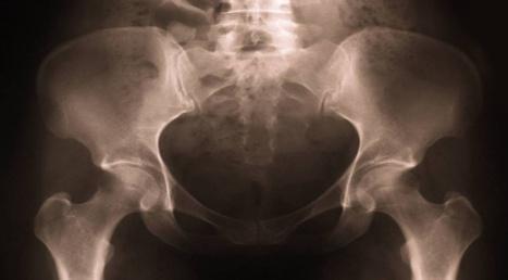 Esimerkki kudossopeutuvuuden (HLA-A,B,C,DRB,DQB,DPB) arvioinnista elinsiirroissa: Luuydinsiirto (graft vs host D) Potilas: HLA-A1,25 B17,18 DR1,13 Veli: HLA-A2,25 B18, 18 DR1,15 HLA-A1,25 B17,18