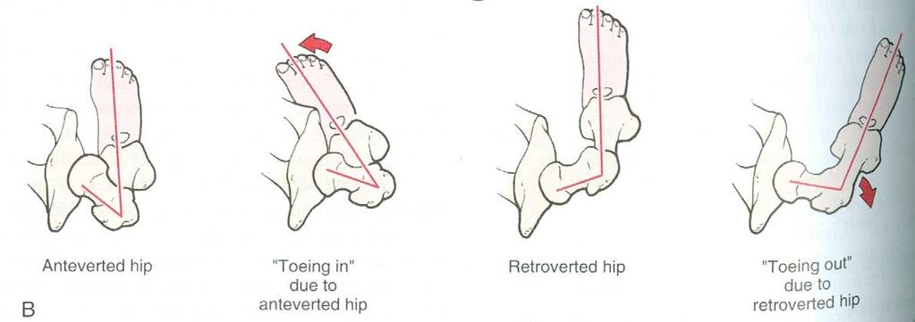 71 Kuva 23. Lonkan anteversion ja retroversion vaikutus alaraajan asentoon (Kuva: Magee 2014, 712).