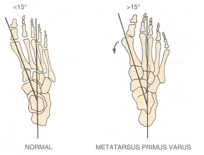 87 Metatarsus primus varus (kuva 27) on ensimmäisen jalkapöytäluun epämuodostuma, jossa ensimmäinen jalkapöytäluu on suuntautunut liiaksi lähennykseen suhteessa muihin jalkapöytäluihin.