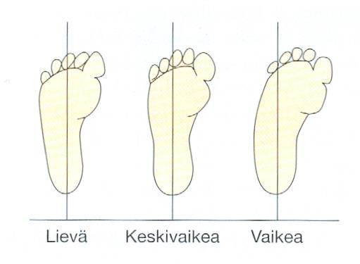 88 Kuva 28. Blecksin luokitus (Kuva: Salonen 2004b, 518). Haglundin deformiteetti havainnoidaan tarkastelemalla kantaluun muotoa.