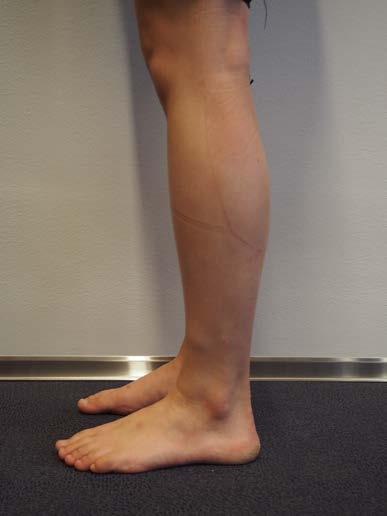 34 KUVA 11. ja 12. Ensimmäisessä kuvassa jalkaterä, jossa jalan etu- ja takaosan mittasuhteet ovat normaalit.