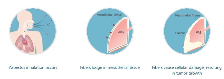 7 asbestikuitujen rikkoessa keuhkoja tai vastakalvoa ympäröivän solukon. Kuitujen kiinnittyessä aiheutuu tulehdus, joka kehittyy vuosien kuluessa kasvaimeksi (Kuvio 2).