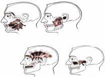 Research diagnostic criteria for temporomandibular disorders: review, criteria, examinations and specifications, critique. J Craniomandib Dis Fac Oral Pain 1992;6:301-55.