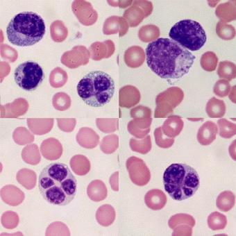 Eräät T-solulymfoomat - syy vai seuraus? Helicobacter - krooninen gastriitti mahalaukun marginaalivyöhykkeen lymfooma Lymfaattiset neoplasiat,, n.