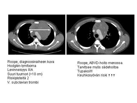 HL hoidon pitkäaikaishaitat Paikallisen stage IA-IIA IIA sekä IB klassisen Hodgkin-lymfooman hoito Sekundaarisyöpä Leukemia ebeacopp 3% 10 v:ssa ABVD < 1% Lymfooma Rintasyöpä RT < 30 v:lle 10-20 %