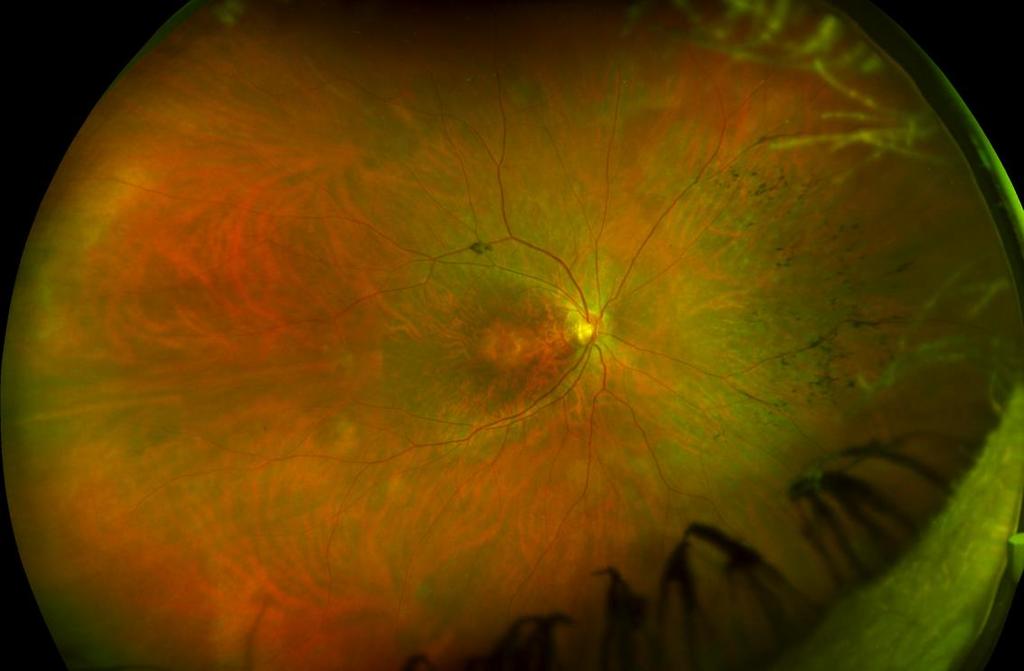 11 Kuvio 3. Retinitis pigmentosan alkuvaiheen silmänpohjamuutokset. Courtesy of Optomap image library 2017.