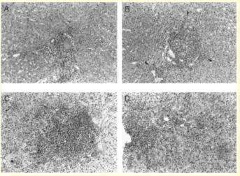 kehittyy maksasyöpä vuosittain C-hepatiitin laboratoriodiagnostiikka Diagnostiikan kulmakivi: HCV-vasta-ainemääritys (HCVAb) Kvalitatiivinen HCV-RNA (HCVNh-O) HCV-Ab Testi on herkkä Soveltuu