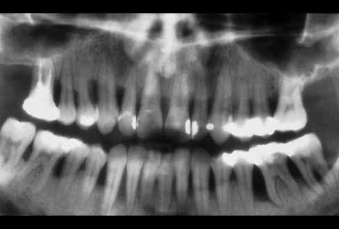 HIV ienmuutoksia Herpes simplex Herpetic gingivostomatitis Irregular