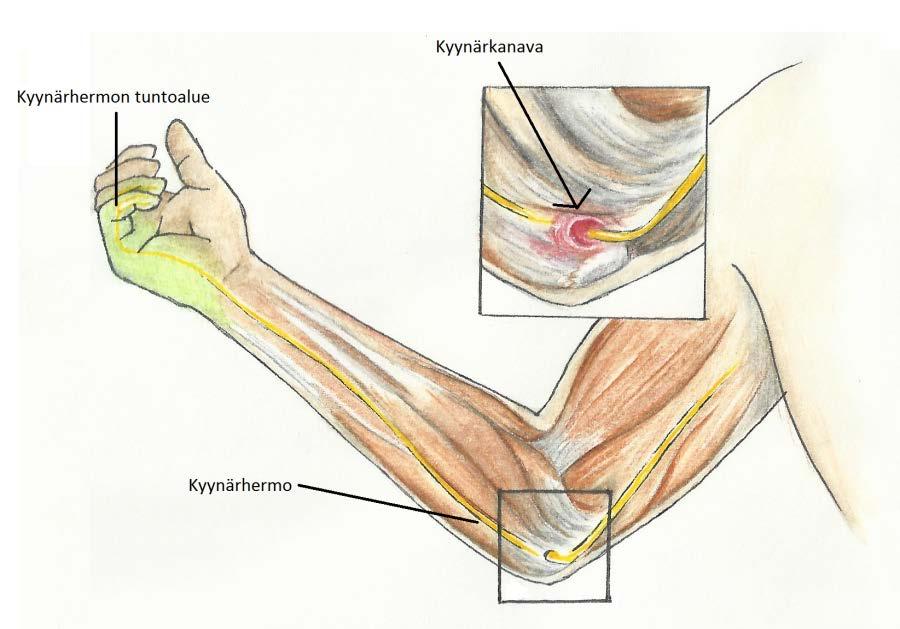 ihon välissä (kuvio 5). Kyynärpään kolauttaminen aiheuttaa säteilevän kivun kyynärpäästä pikkusormeen ja nimettömän sormeen.