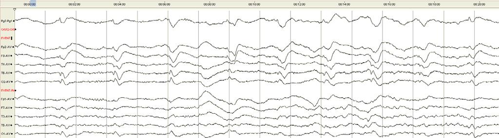 Nonkonvulsiivinen SE EEG:ssä jatkuvasti teräviä aaltoja oikealla