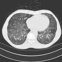 KUVA 3. Pneumocystis jiroveciin aiheuttama keuhkokuume. HRTT-kuvassa nähdään crazy paving muutosta eli mattalasitiivistymää ja interstitiumin paksuuntumiseen liittyvää verkkomaista kuvioitusta.