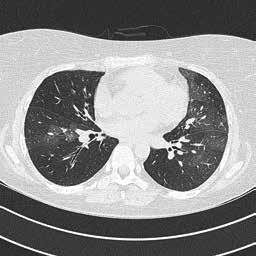 HRTT:n käyttöaiheita KUVA 5. Ahtauttava bronkioliitti. Uloshengityskuvissa nähdään laajoja ilmasalpausalueita, joihin liittyy keuhkoverisuonien kaventumistakin.