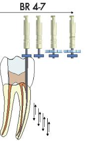 Pyörivien koneviilojen käyttö: Lopullinen apikaalinen preparointi BR4 - BR7 17 Lopullinen apikaalinen preparointi saadaan aikaan neljällä instrumentilla BR4 - BR7 riippuen kanavan anatomiasta