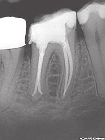 04 Hammas 46 Oireeton apikaalinen periodontiitti.