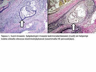 C) Syöpäsolujen invaasio laskimorakenteeseen (nuolet) oikealla olevassa elastiinivärjäyksessä (HEperusvärjäys). Omat potilaat Potilas 1.