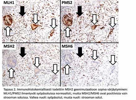 Oikealla oleva kuva osoittaa, että vitaaleja syöpäsoluja oli kuitenkin helppo löytää (kohtalainen hoitovaste). C) Immunohistokemiallisesti todettiin MSH2-geenimutaatioon sopiva värjäyty minen.