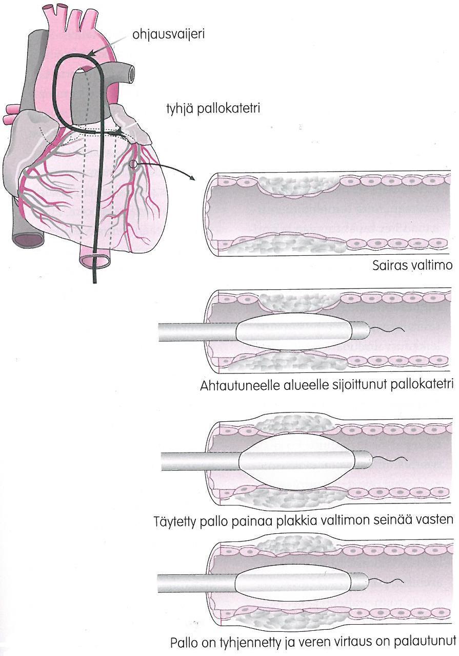 16 Kuva 4. Pallolaajennus. (Holmia ym. 2006, 213.) Pallolaajennuksen kustannustehokkuus, toipumisen nopeus sekä toimenpiteen keveys ovat merkittäviä etuja.