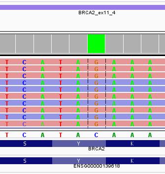 Patogeeninen variantti? Miehen rintasyöpä hoidettu 2007, selvitetään perinnöllisyyttä TULOS: Tutkitussa näytteessä todetaan BRCA2-geenin mutaatio c.