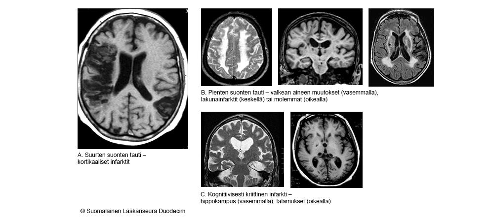 KUVA 5. Vaskulaariseen kognitiiviseen heikentymään liittyvän aivoverenkiertosairauden päätyypit ja niitä kuvaavat aivojen magneettikuvalöydökset Oireiden alku on useimmiten nopea (tunteja, päiviä).