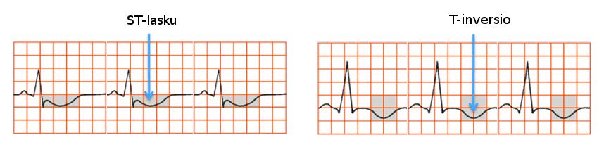 2 STEMI johtuu yleensä sepelvaltimon täydellisestä tukoksesta ja siihen liittyvät sydänsähkökäyrän ST-segmentin nousut niissä EKG-kytkennöissä, jotka kuvastavat hapenpuutteesta kärsivää sydänlihaksen