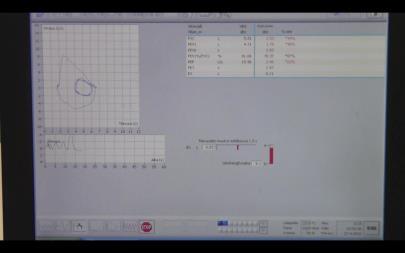 vitaalikapasiteetin mittauskäyrä Videokuva tietokoneen