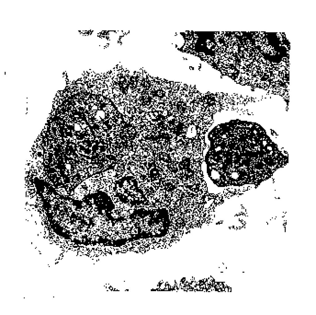 ITP = idiopatic thrombocytopenic