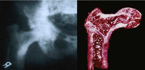 Hypervaskulaarinen / osteolyyttinen vaihe initial phase of disorder involves bone resorption by osteoclasts subsequently there is vigorous osteoblastic response, producing excessive, poorly