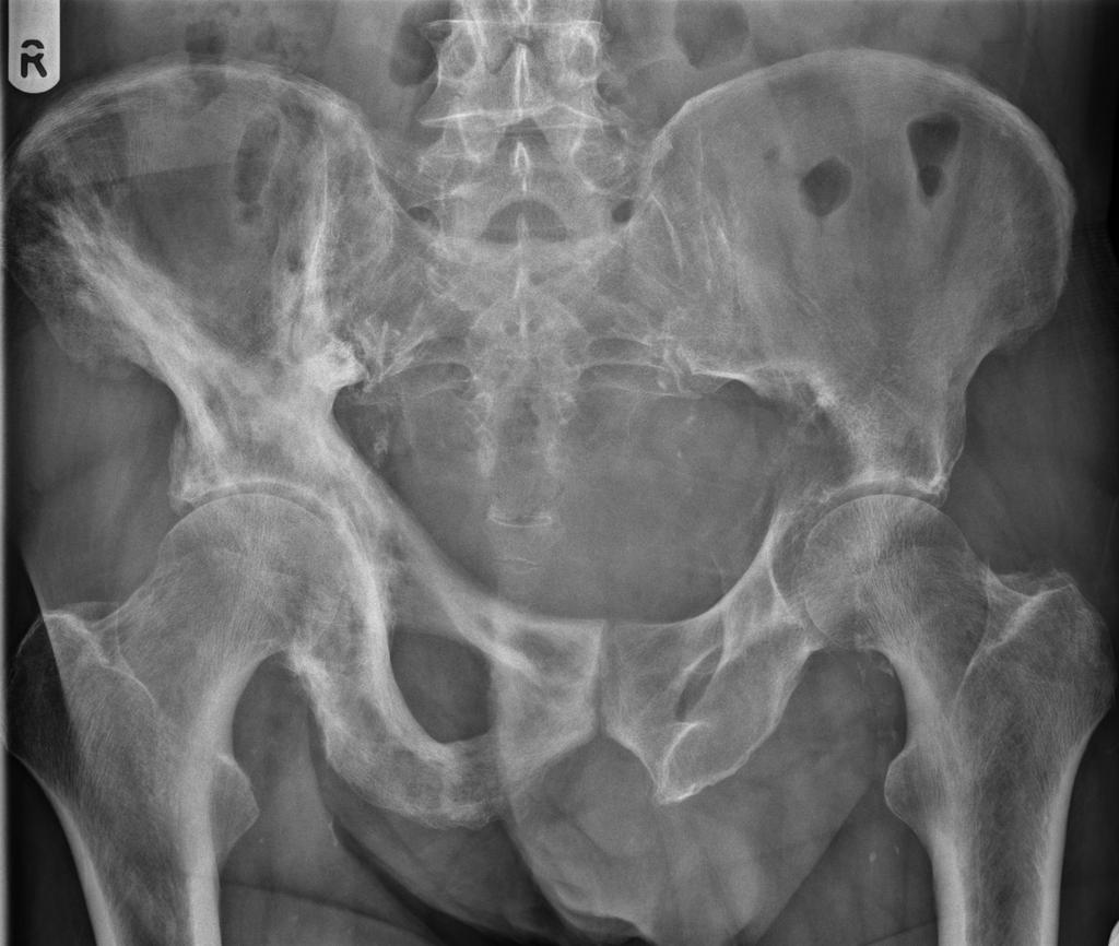 Intermediate Phase in this phase osteoblastic activity predominates, but osteolytic activity is also present and therefore bone structural changes and bone deformity are manifest Quiescent stage