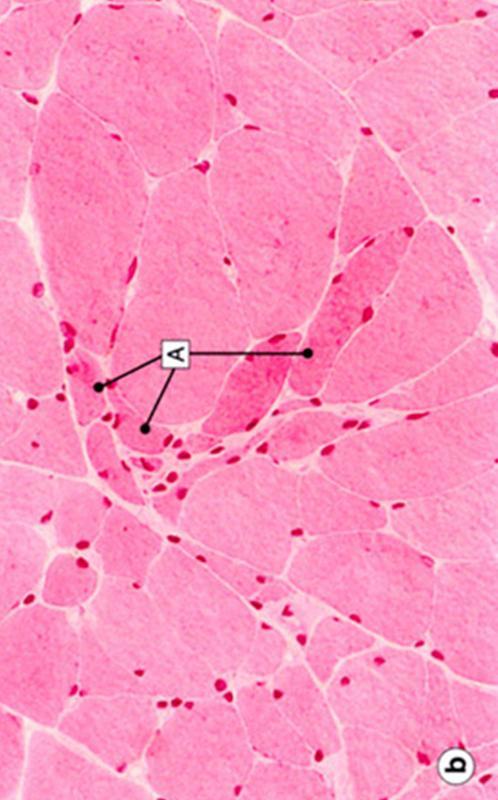 Histologian ja osin patologian termejä Normaali histologinen rakenne?