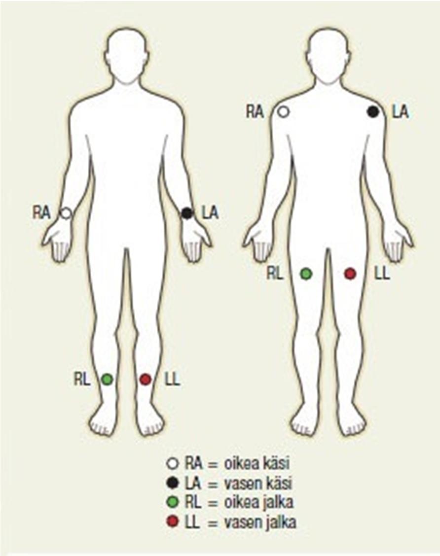 10 Kuva 1. Raajakytkennät (Laine 2014 A). Raajakytkennät sijoitetaan potilaan ranteisiin ja nilkkoihin yleensä mediaalipuolelle (Heikkilä & Mäkijärvi 2003, 41).