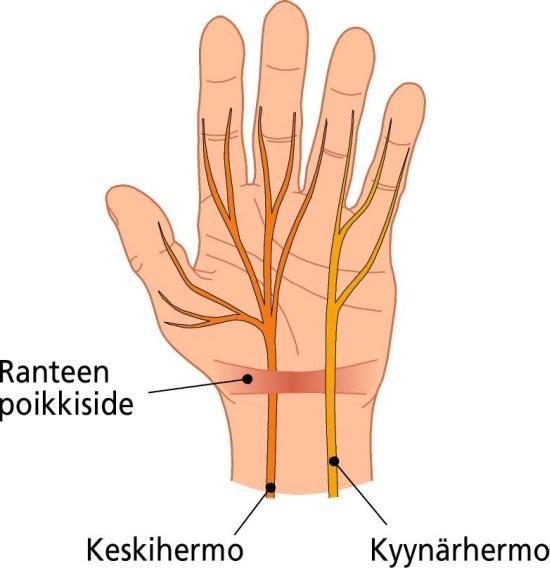 tutkimusten mukaan rannekanavaoireyhtymää esiintyy noin 4 5 %:lla naisista ja noin 2 3 %:lla miehistä. (2; 3.) KUVA 1.