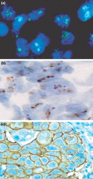 HER-2/neu testing in breast cancer (a) HER-2/neu gene amplification detected by fluorescent in situ hybridization (FISH; Ventana Inform System).