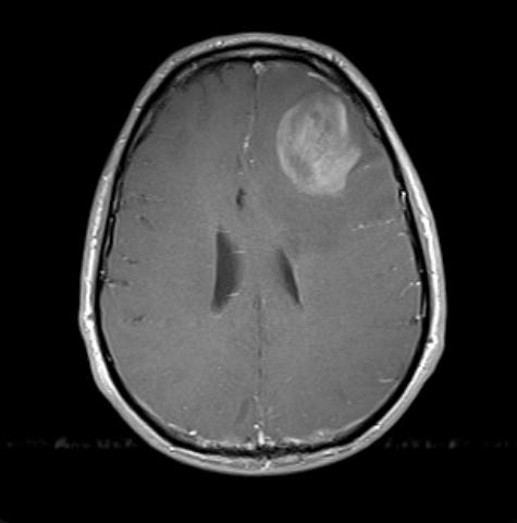 19 Kuva 5: Anaplastinen