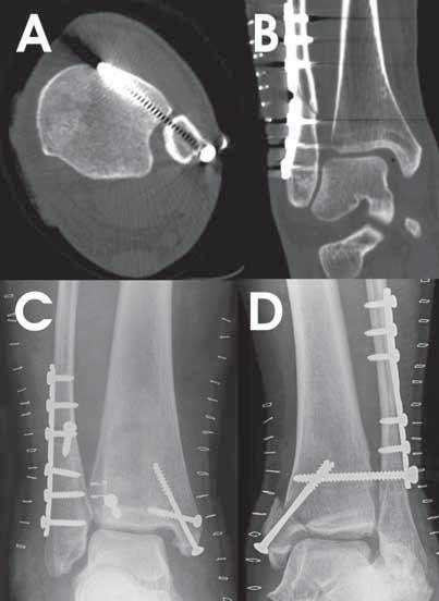 Taulukko 1. Radiologinen syy uusintaleikkaukseen (n=79) maan liittyvät röntgenkuvat murtuman paranemisen seuranta-ajalta.