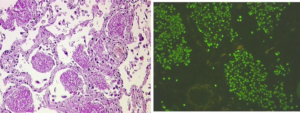 Potilastapaus 43-v nainen, fibromuskulaarisen dysplasian vuoksi