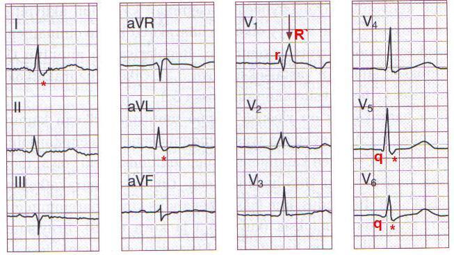 Monimuotoinen QRS
