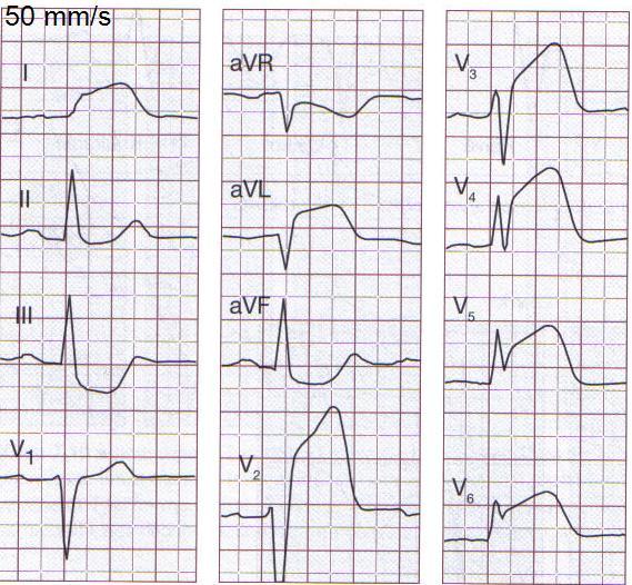 QRS -kompleksit monimuotoisia.