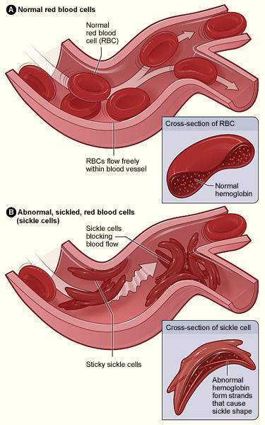 Raudanpuuteanemia: hypokromia,