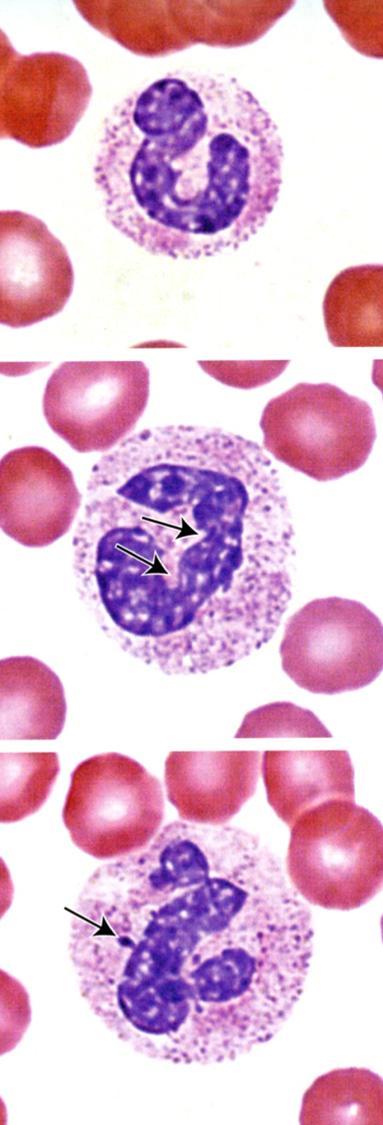 6p 2010, LWW Neutrofiili granulosyytti Tuma on liuskottunut Lysosomit (=azurofiiliset granulat) ovat tiiviitä Runsaasti jyväsellisiä rakkuloita sytoplasmassa