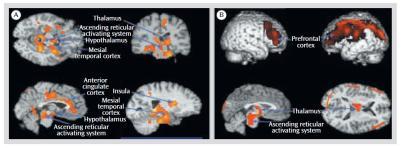 Plos One, in press 44 Epigeneettinen adaptaatio työstressiin DNA:n käsittely bisulfiitilla + sekvensointi Metylaation määritys nukleotidin tarkkuudella Epigeneettinen adaptaatio työstressiin