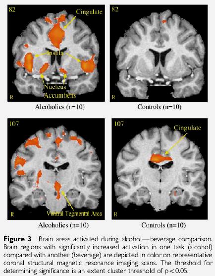 Aivojen aktivaatio visuaalisten alkoholivihjeiden ja yhden olutkulauksen johdosta alkoholisteilla ja verrokeilla