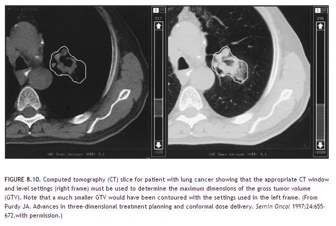 GTV:n rajaaminen SuunnitteluCT: ikkunointi, MRI,