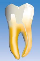 Ennen Endoflaren käyttöä dentiiniporras nähtävissä. Endoflaren käyttö. Erittäin yksinkertainen käyttö Pyörimisnopeus 300 600 rpm Tekniikka Avaa ja laajenna kanava aluksi nro 10 käsiviilalla 21 mm tai 25 mm.