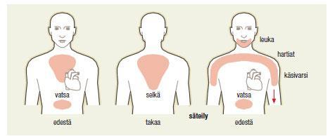 11 hengenahdistusta ja iho voi olla kalpea ja kylmänhikinen. (Castren ym. 2010, 294; Mustajoki, 2012, sydäninfarkti.