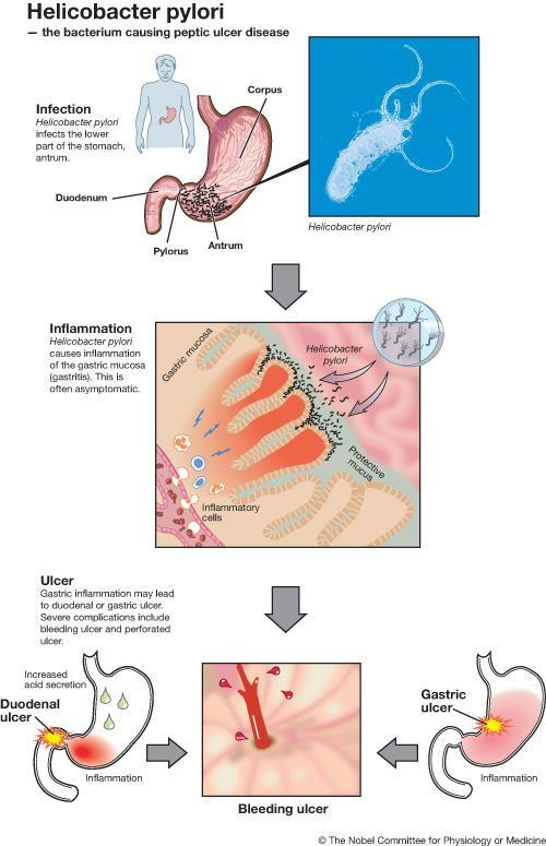 Robin Warren for their discovery of "the bacterium