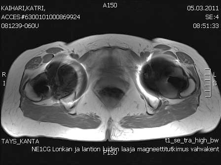 MRI Intra-artikulaarisesti rajoittunut